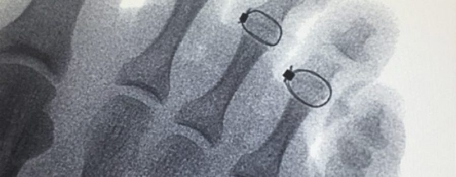 Hammertoe correction presents real-world challenges