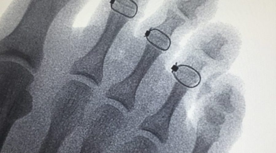 Hammertoe correction presents real-world challenges