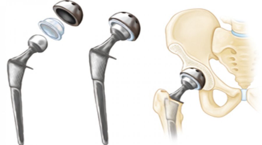 Total Hip Replacement